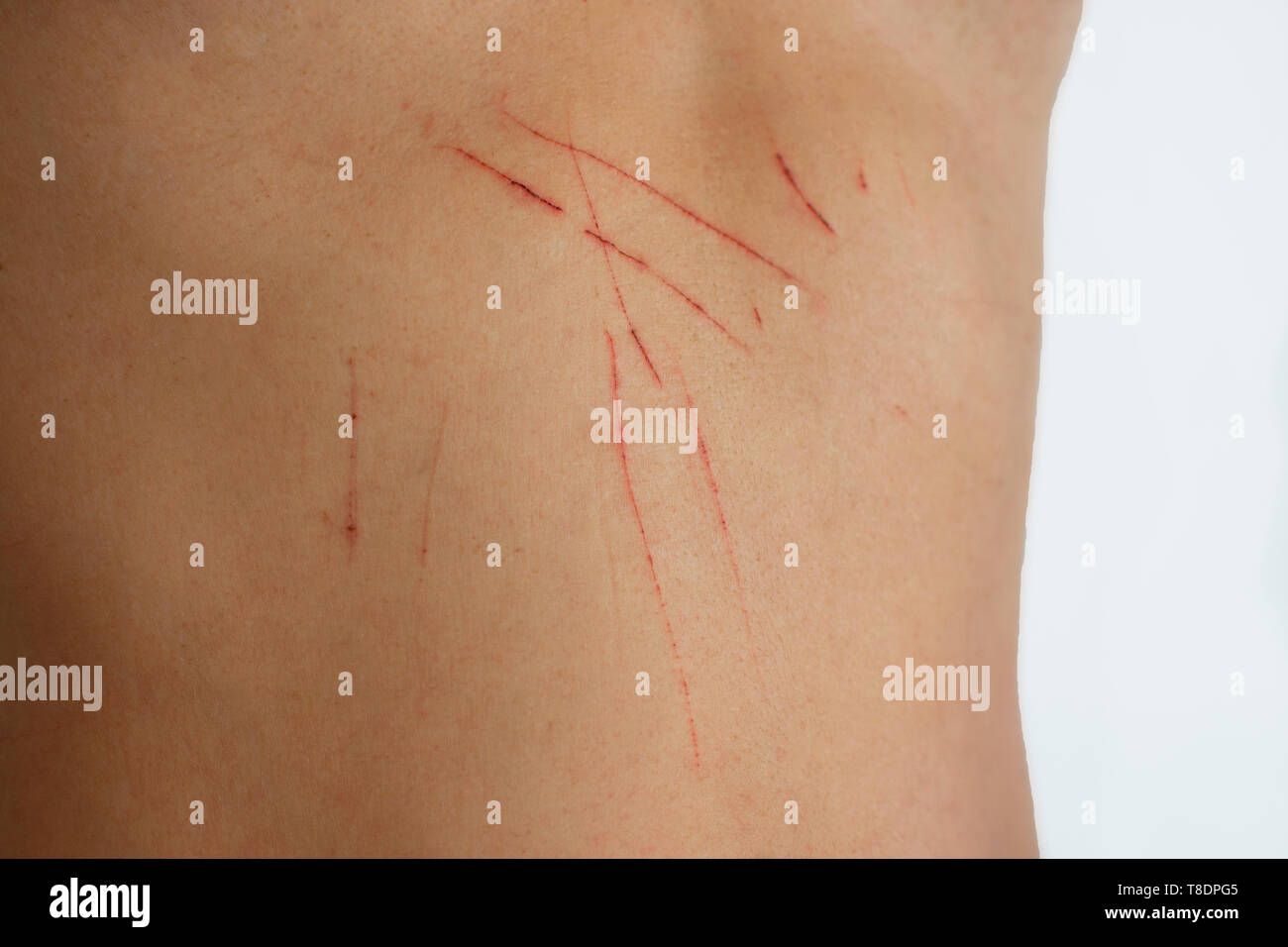 Wunden auf der Haut Katze Kratzern. Haut mit Wunden. irritierte Haut. Pflege der Haut Wunden im Sommer. Weißer Hintergrund Stockfoto