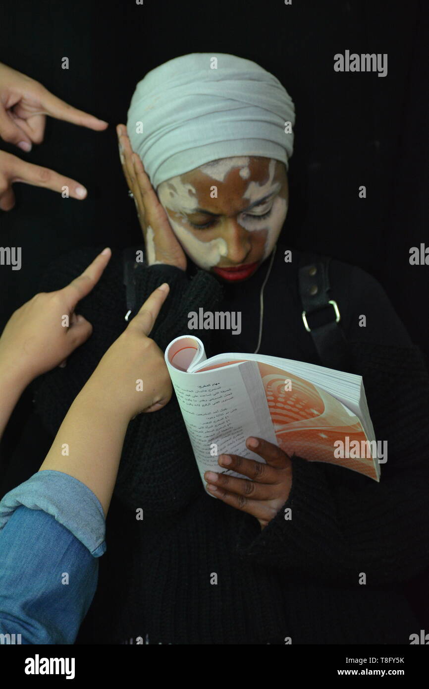 Die Leiden der Vitiligo Stockfoto