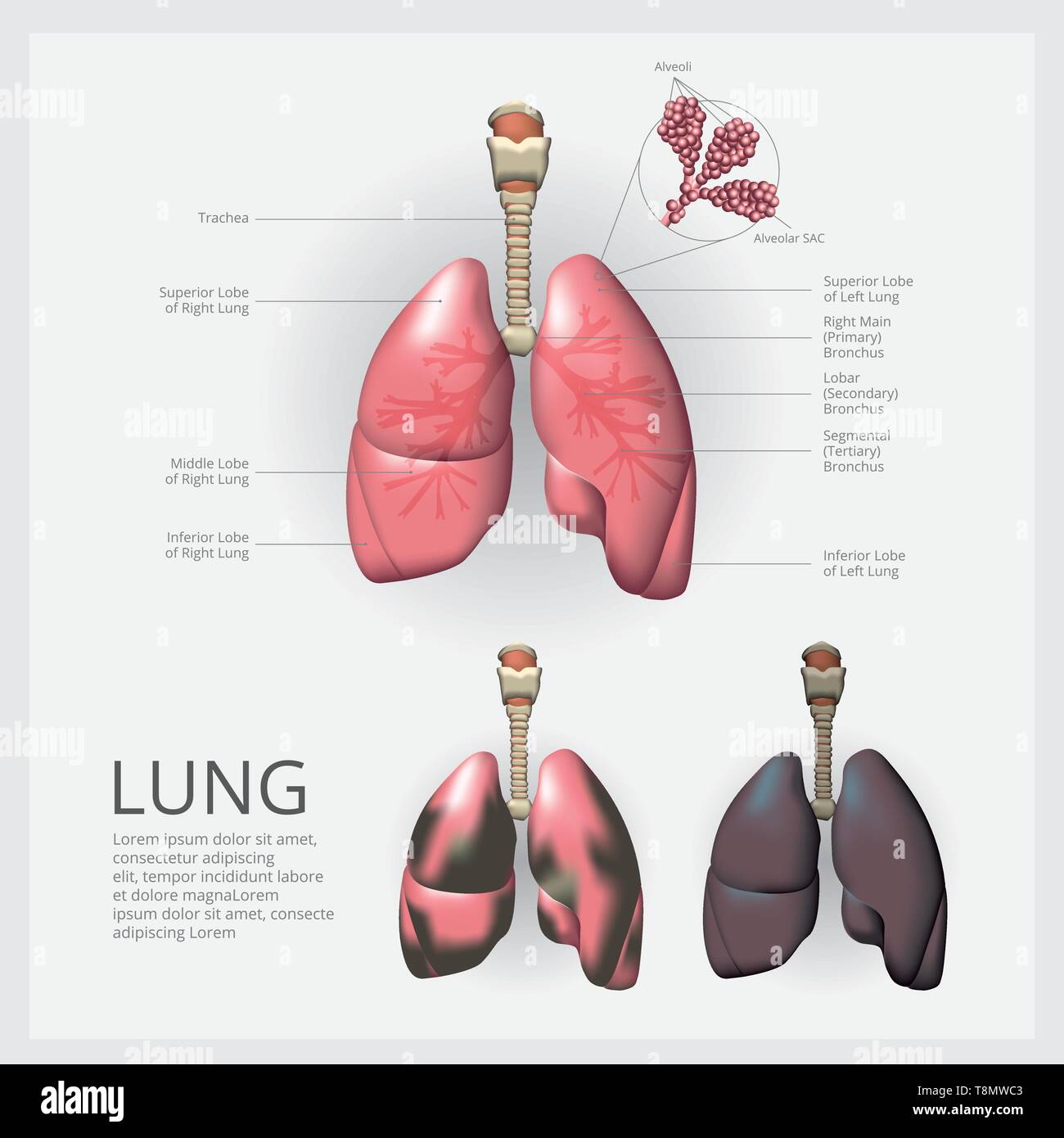 Lunge mit Detail- und Lungenkrebs Vector Illustration Stock Vektor