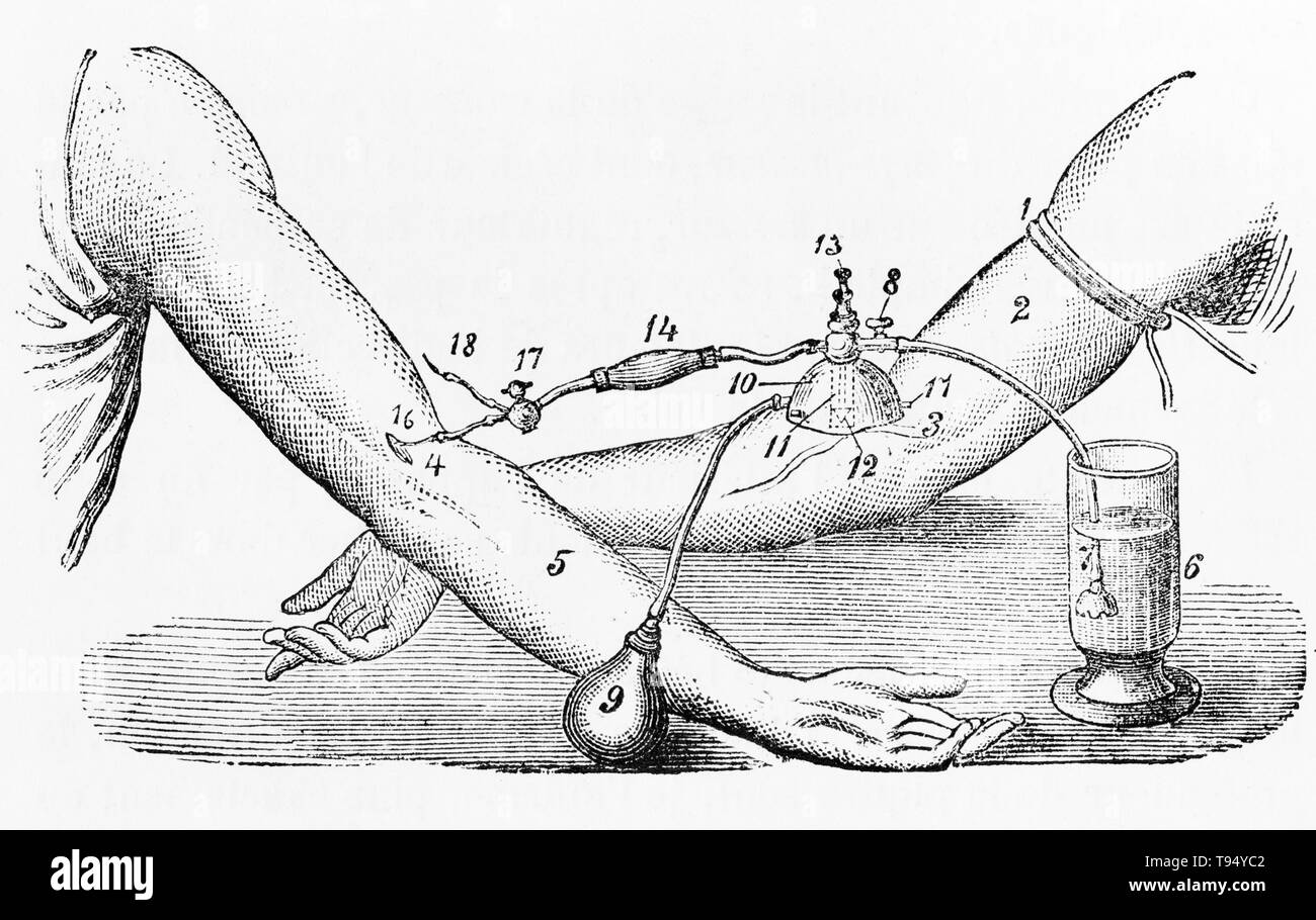 Bluttransfusion zwischen zwei Menschen, J. Roussel, 1876. Beginnend mit Harvey's Experimente mit Zirkulation des Bluts, Forschung im Bereich der Bluttransfusion im 17. Jahrhundert begann, mit erfolgreichen Experimente in Transfusion zwischen den Tieren. Jedoch aufeinanderfolgende Versuche durch Ärzte tierisches Blut in den Menschen zu л gab variabel, oft tödlich, Ergebnisse. Frühe Transfusionen zwischen Menschen waren riskant und viele in den Tod des Patienten geführt. Es war nicht bis 1901, als die österreichische Karl Landsteiner entdeckt menschlichen Blutgruppen, dass Bluttransfusionen sicherer geworden. Stockfoto