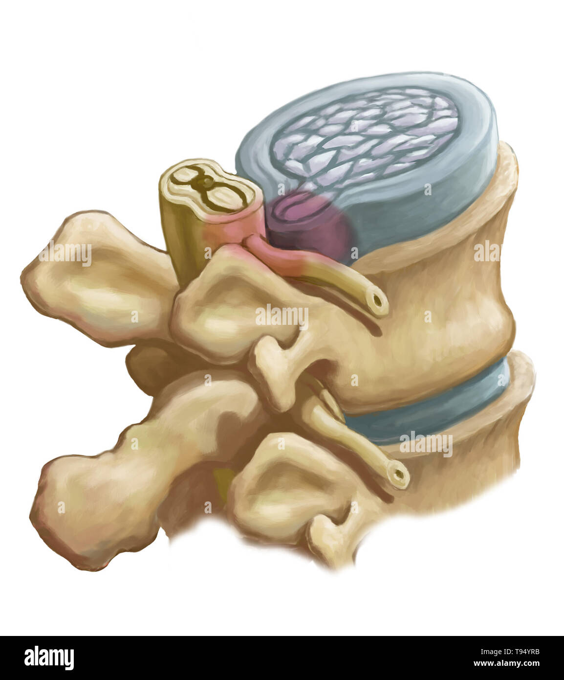 Eine Abbildung der Bandscheibenvorfall eine Bandscheiben in der Lendenwirbelsäule. Personen leiden unter einem Bandscheibenvorfall, wenn die äußere fibrösem Gewebe der Festplatte, bekannt als der Anulus fibrosus können durch Trauma oder Alter, bersten. Als ein Ergebnis, das Gel - wie Mitte der Scheibe herausragt, nach außen und drückt die Nerven in der Rückseite, Schwächung der Muskulatur und verursachen schwere lokale Rückenschmerzen. Stockfoto