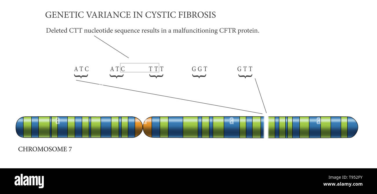 Zystische Fibrose Chromosom, Illustration. Mukoviszidose ist eine genetische Störung, die vor allem die Lunge, sondern auch die Bauchspeicheldrüse, Leber, Nieren und Darm. Es ist durch die Anwesenheit von Mutationen in beiden Kopien des Gens für die Cystic Fibrosis Transmembrane Conductance Regulator Protein verursacht. Stockfoto
