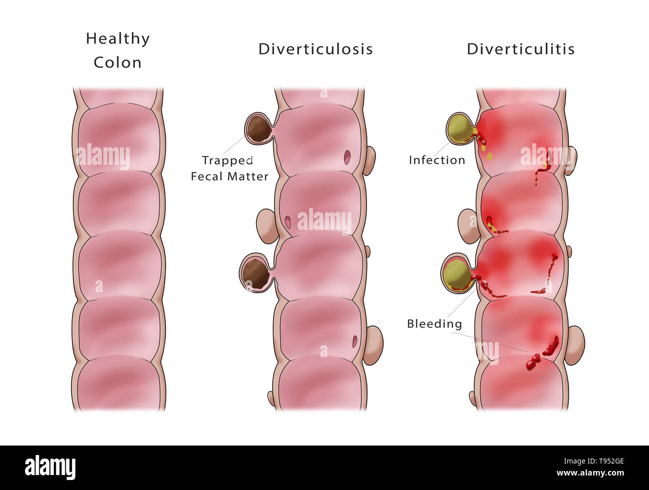 Abbildung: Vergleich diverticulosis Diverticulitis (Mitte) und (rechts). Ein gesunder Darm ist auf der linken Seite angezeigt. Stockfoto