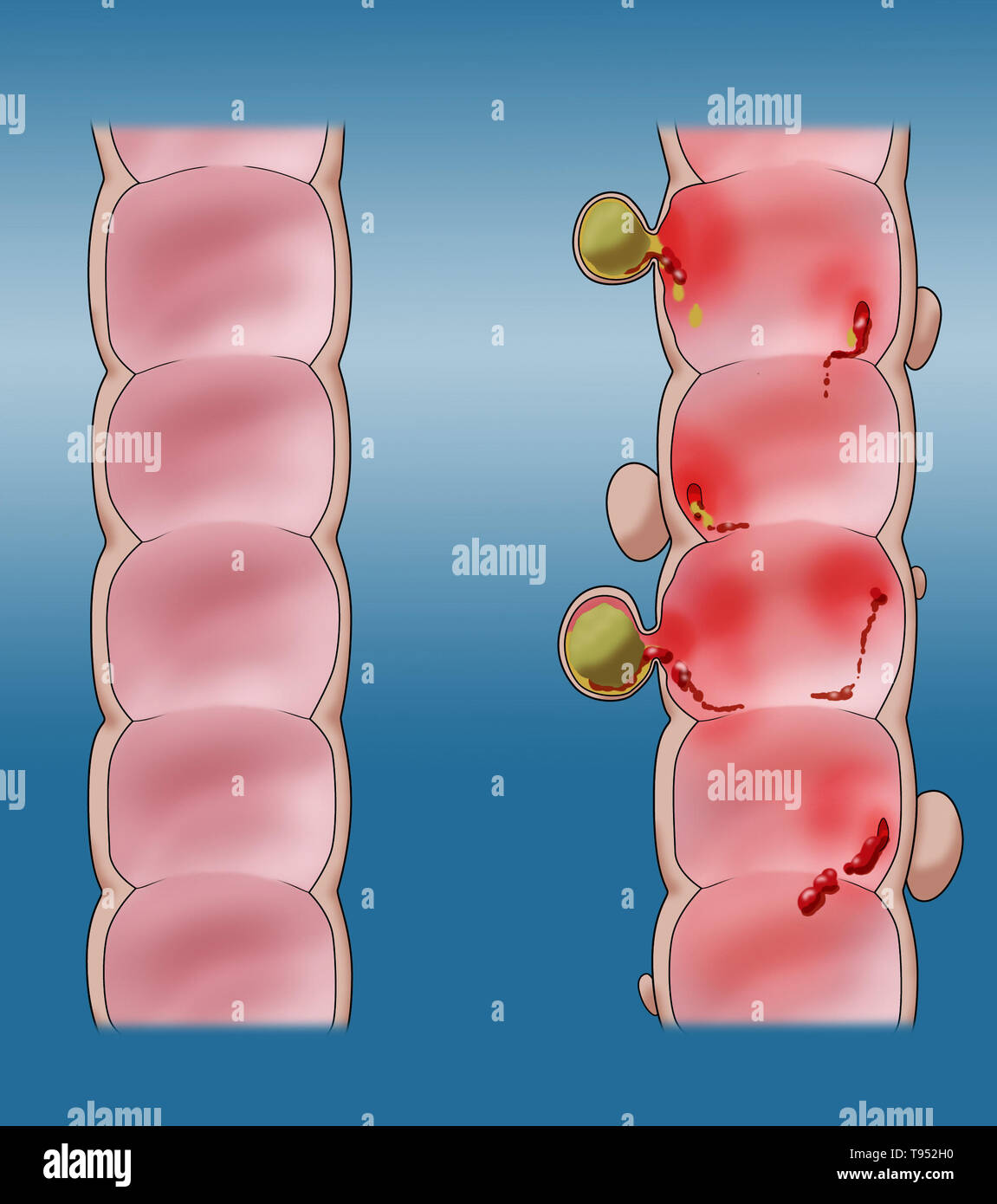 Abbildung: Vergleich einer gesunden Doppelpunkt (links) und einen Doppelpunkt mit divertikulitis (rechts). Stockfoto