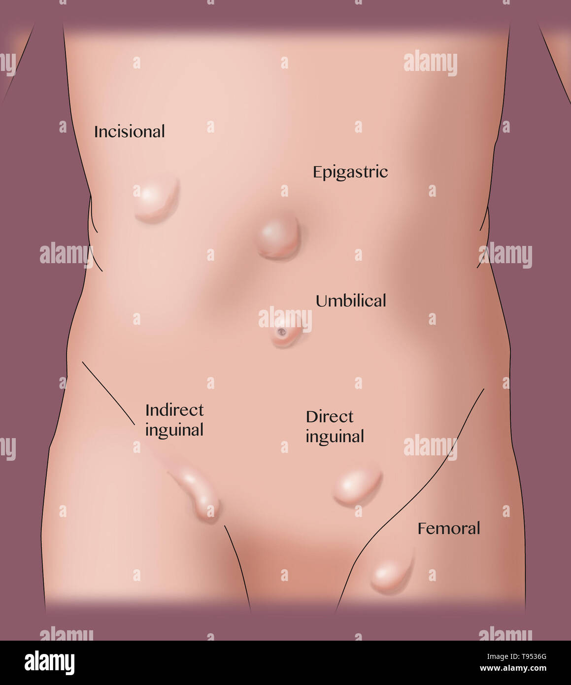 Eine Abbildung zeigt die verschiedenen Arten von Hernien. Stockfoto