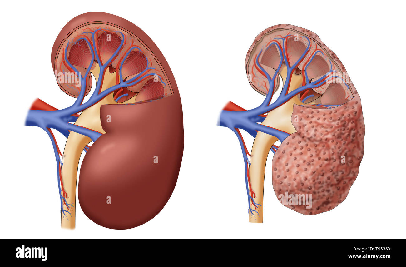 Ein Beispiel für eine Niere mit chronischen Nierenerkrankungen (rechts), neben einer gesunden Niere (links). Stockfoto