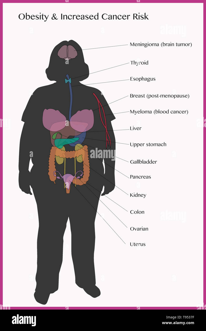Zeigt den Krebs Risiken der Fettleibigkeit. Stockfoto
