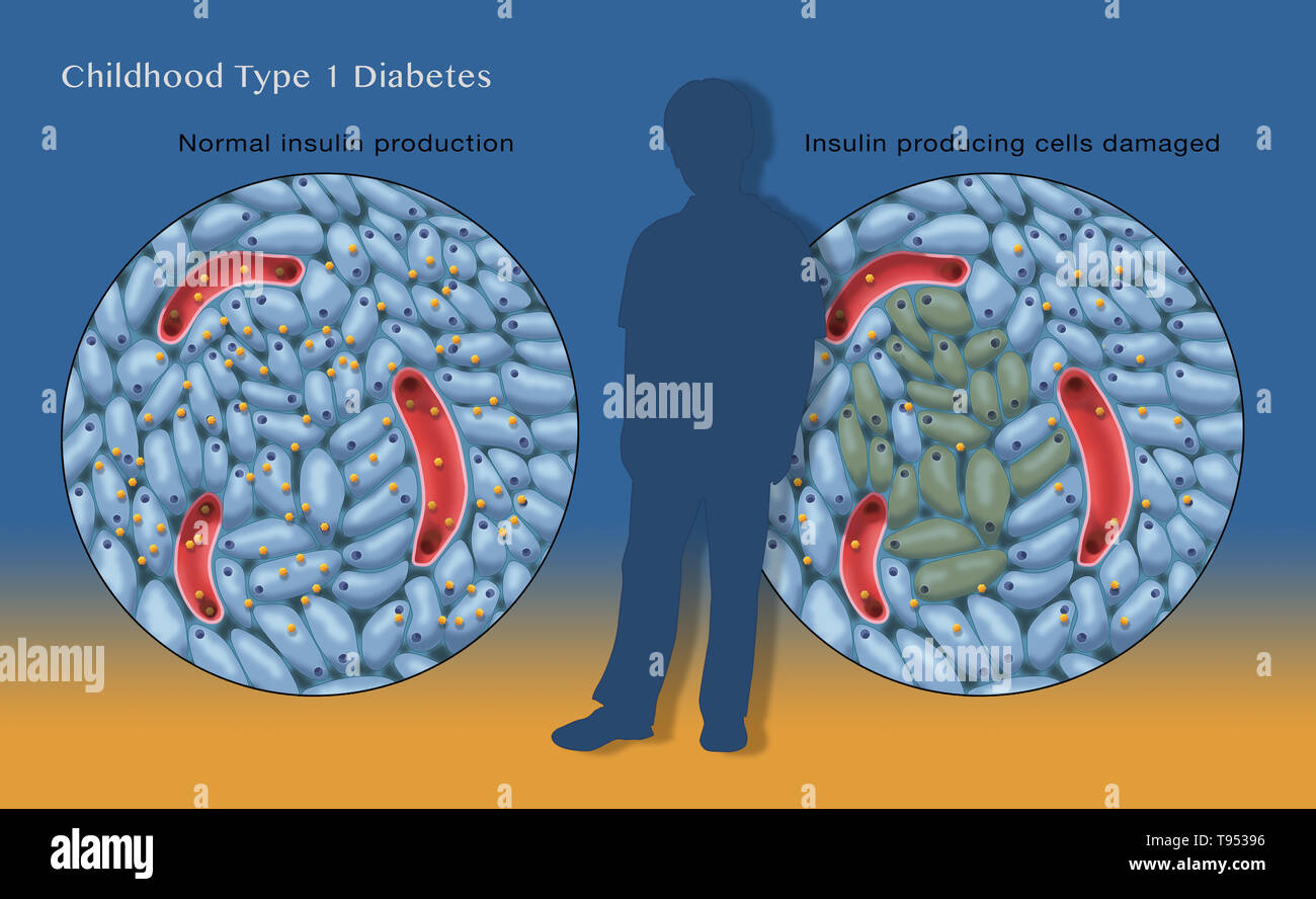 Eine Abbildung zeigt normale Insulin (links) und Beschädigung der Insulin-produzierenden Zellen (rechts) in der Kindheit, Typ 1 Diabetes. Stockfoto