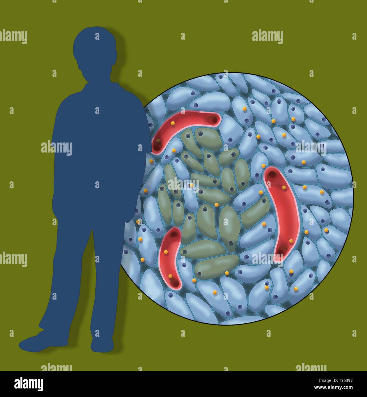 Eine Abbildung mit beschädigten Insulin-produzierenden Zellen in der Kindheit Diabetes Typ 1. Stockfoto