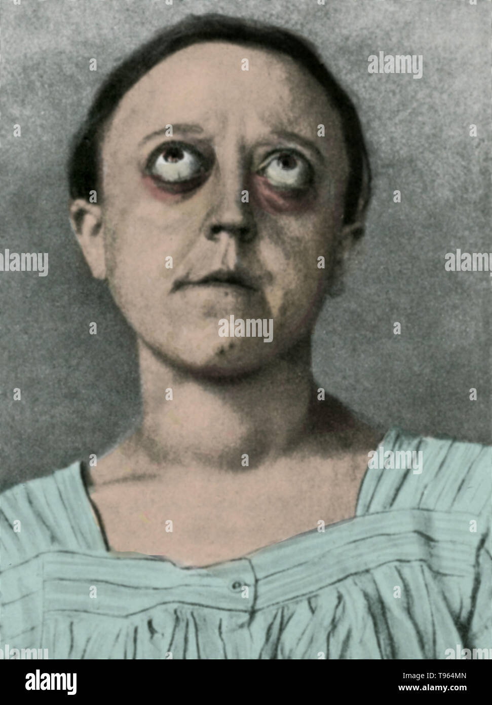 Eine historische Abbildung eines Patienten mit Graves' ophthalmopathy (auch als Krankheit der Gräber, Graves' Schilddrüse-assoziierten oder dysthyroid Orbitopathy), eine autoimmune entzündliche Erkrankung, die die Umlaufbahn des Auges, mit oder ohne Schilddrüse Störung bekannt ist. Stockfoto