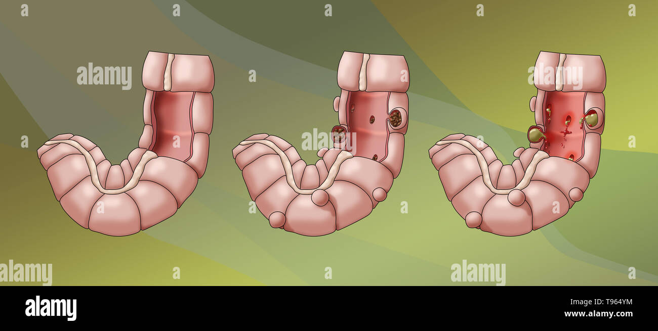 Abbildung: Vergleich der Darstellung eines gesunden Doppelpunkt (links); diverticulosis (Mitte) und Divertikulitis (rechts). Stockfoto