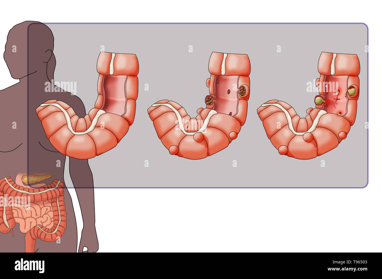 Abbildung: Vergleich der Darstellung eines gesunden Doppelpunkt (links), (Mitte), Divertikulose und Divertikulitis (rechts); eine weibliche Silhouette mit dem Verdauungssystem markiert ist im Hintergrund. Stockfoto