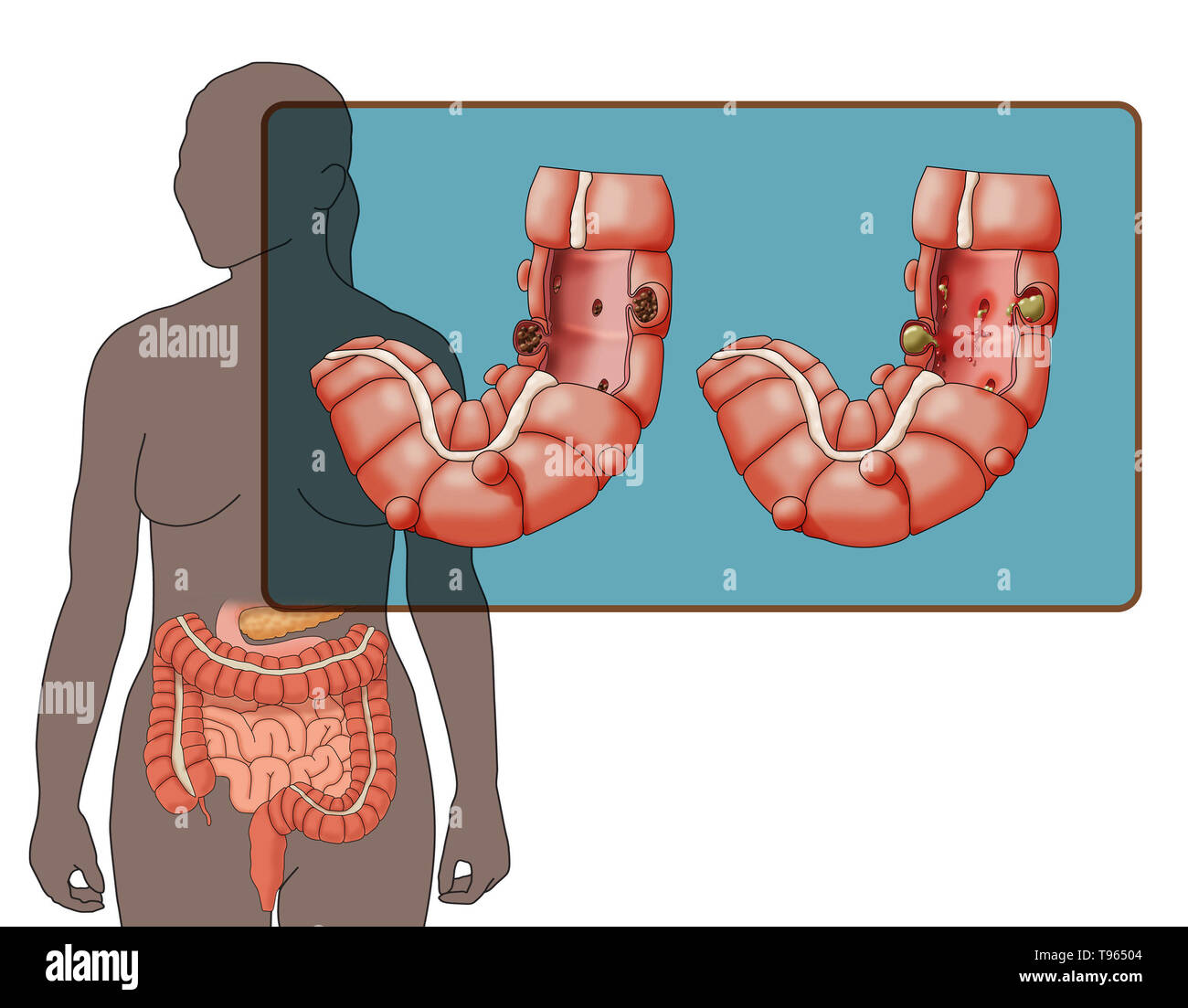 Abbildung: Vergleich der Darstellung von divertikulose und Divertikulitis (links) (rechts); eine weibliche Silhouette mit dem Verdauungssystem markiert ist im Hintergrund. Stockfoto