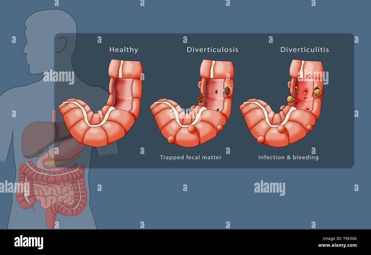 Abbildung: Vergleich der Darstellung eines gesunden Doppelpunkt (links), (Mitte), Divertikulose und Divertikulitis (rechts); ein männlicher Silhouette mit dem Verdauungssystem markiert ist im Hintergrund. Stockfoto