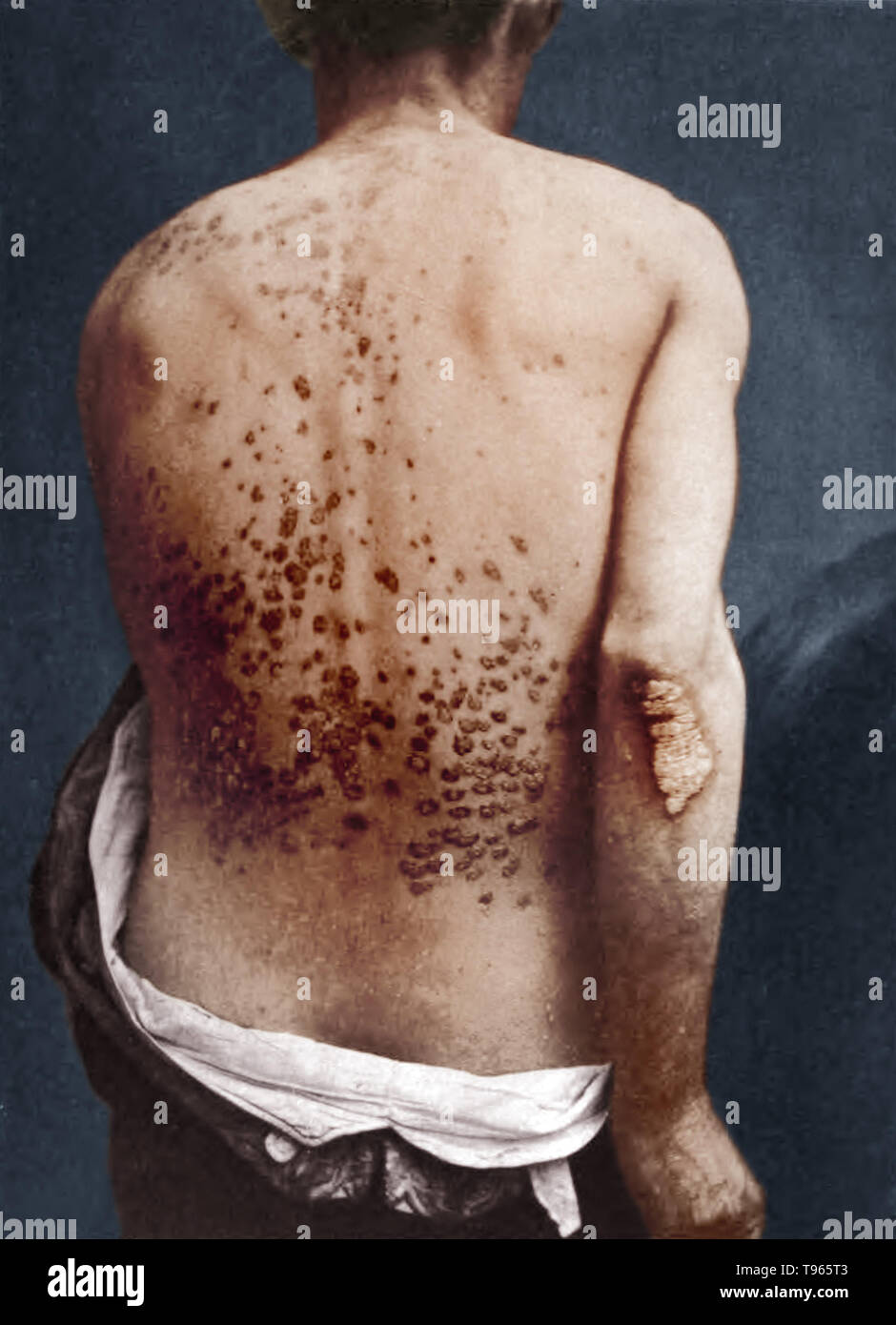 Psoriasis guttata auf dem Rücken und Arm eines Menschen, der von George Henry Fuchs, 1886 fotografiert. Psoriasis guttata ist eine Hauterkrankung, die in Form von kleinen Läsionen auf der Haut nimmt. Es ist in der Regel das Ergebnis einer bakteriellen Infektion. Das Wort guttata ist vom lateinischen Wort gutta abgeleitet und bedeutet. Stockfoto
