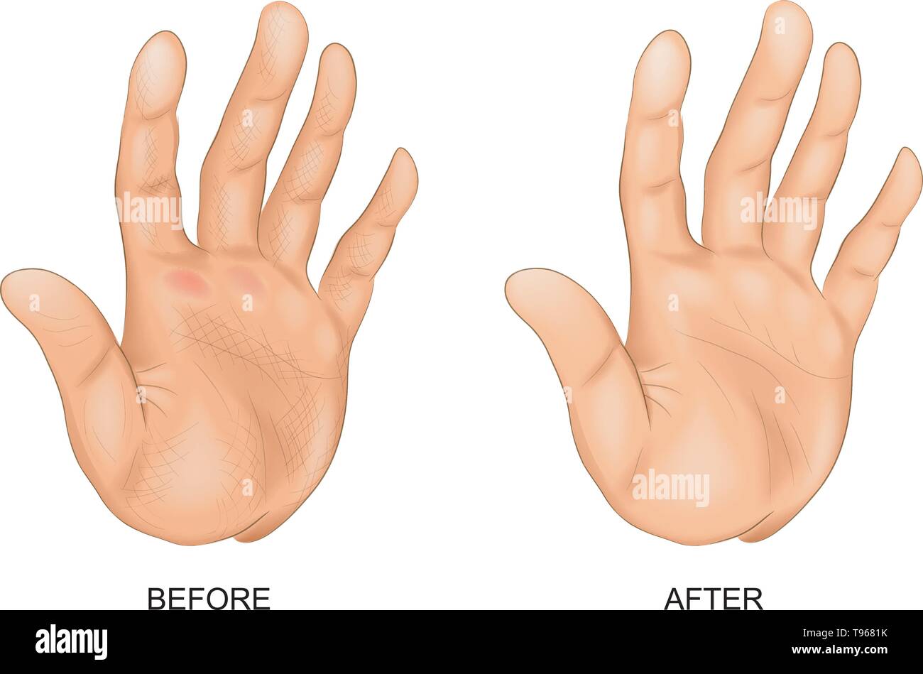 Vector Illustration von Hand mit rauher Haut und Hand nach Spa Behandlungen Stock Vektor