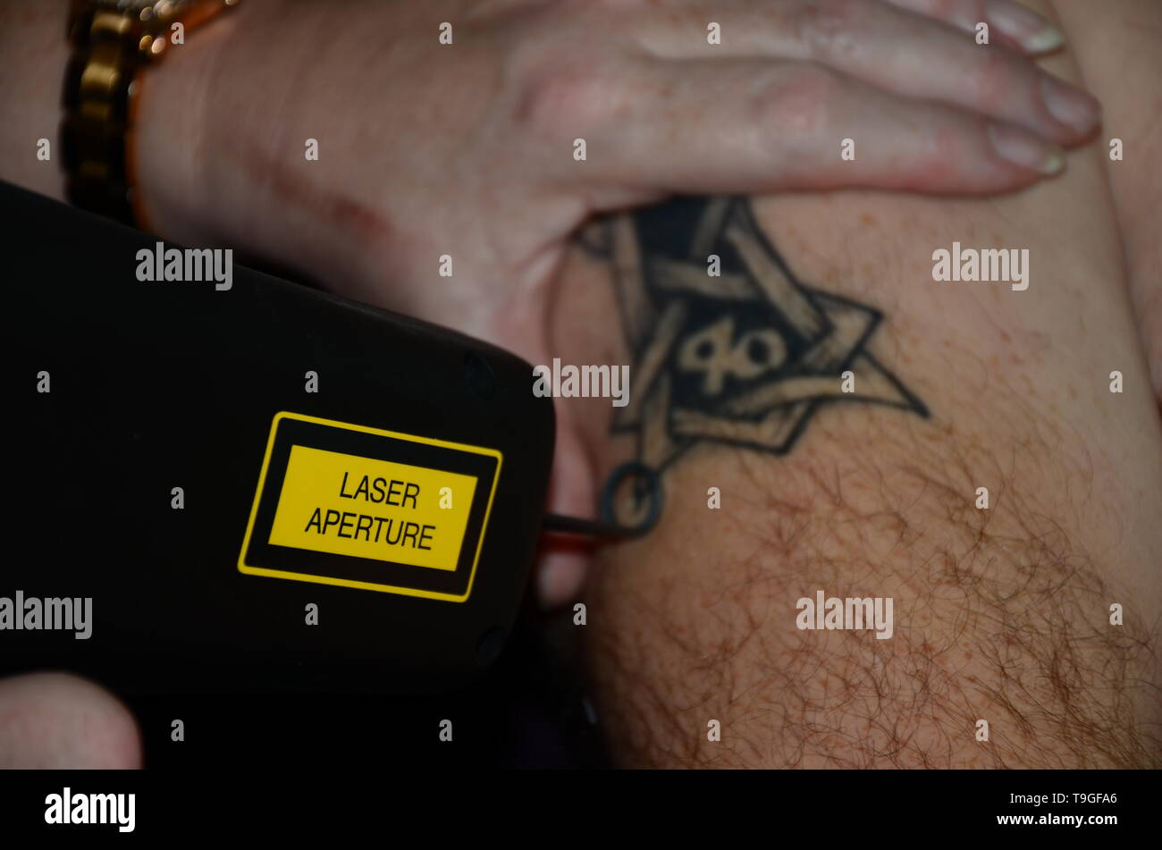 Laser Tattooentfernung Maschine, bedauernd Tattoos Stockfoto