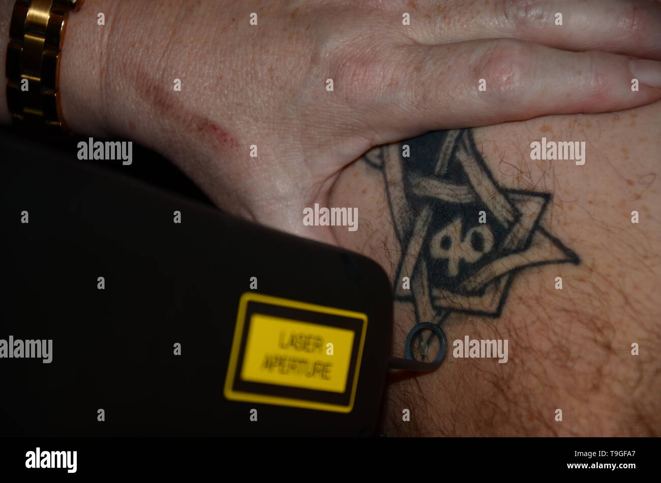 Laser Tattooentfernung Maschine, bedauernd Tattoos Stockfoto