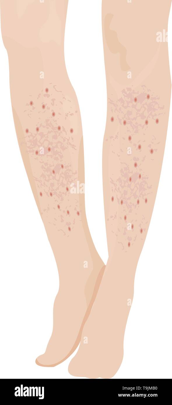 Psoriasis auf weibliche Beine Vector Illustration Stock Vektor
