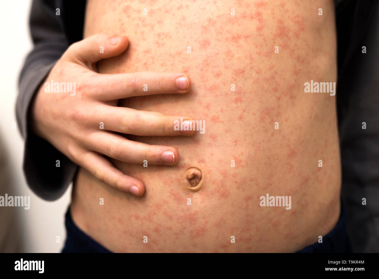 Kranken Kind Körper, Bauch mit roten rush Spots von Masern oder Windpocken. Ansteckend Kind Krankheiten und Behandlung. Stockfoto