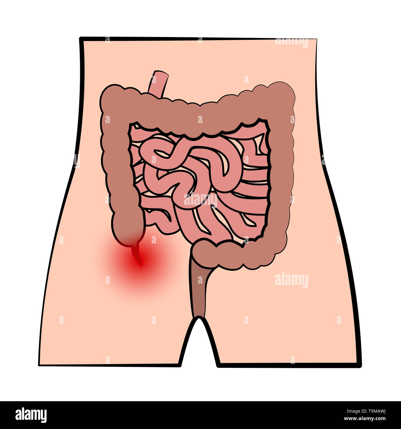 Entzündete Anhang. Schematische Darstellung der blinddarmentzündung und das Verdauungssystem auf weißem Hintergrund. Stockfoto