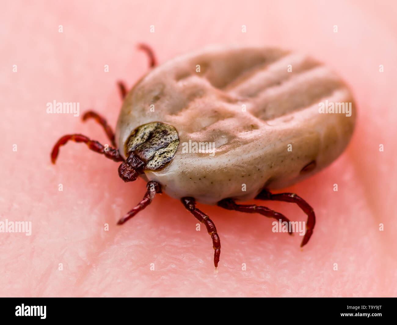 Enzephalitis Virus oder Lyme Krankheit infizierten Zecke Dermacentor Spinne Insekt auf der Haut Makro Stockfoto