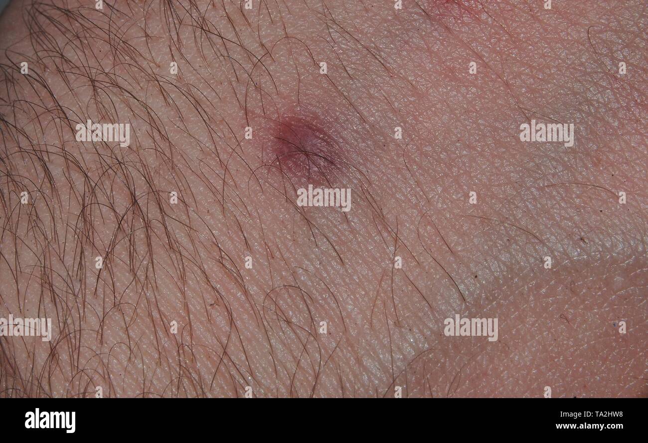 Narbe auf der Haut der Hand aus einem chemischen Verbrennungen. Verletzung. Stockfoto