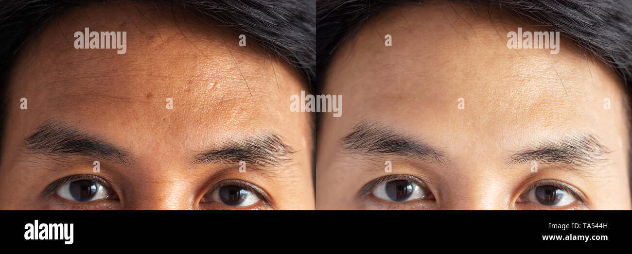 Zwei Bilder im Vergleich vor und nach der Behandlung. Haut mit Sommersprossen, Pore, stumpfe Haut und Falten um Stirn Vor- und Rückwärtsbewegung Stockfoto