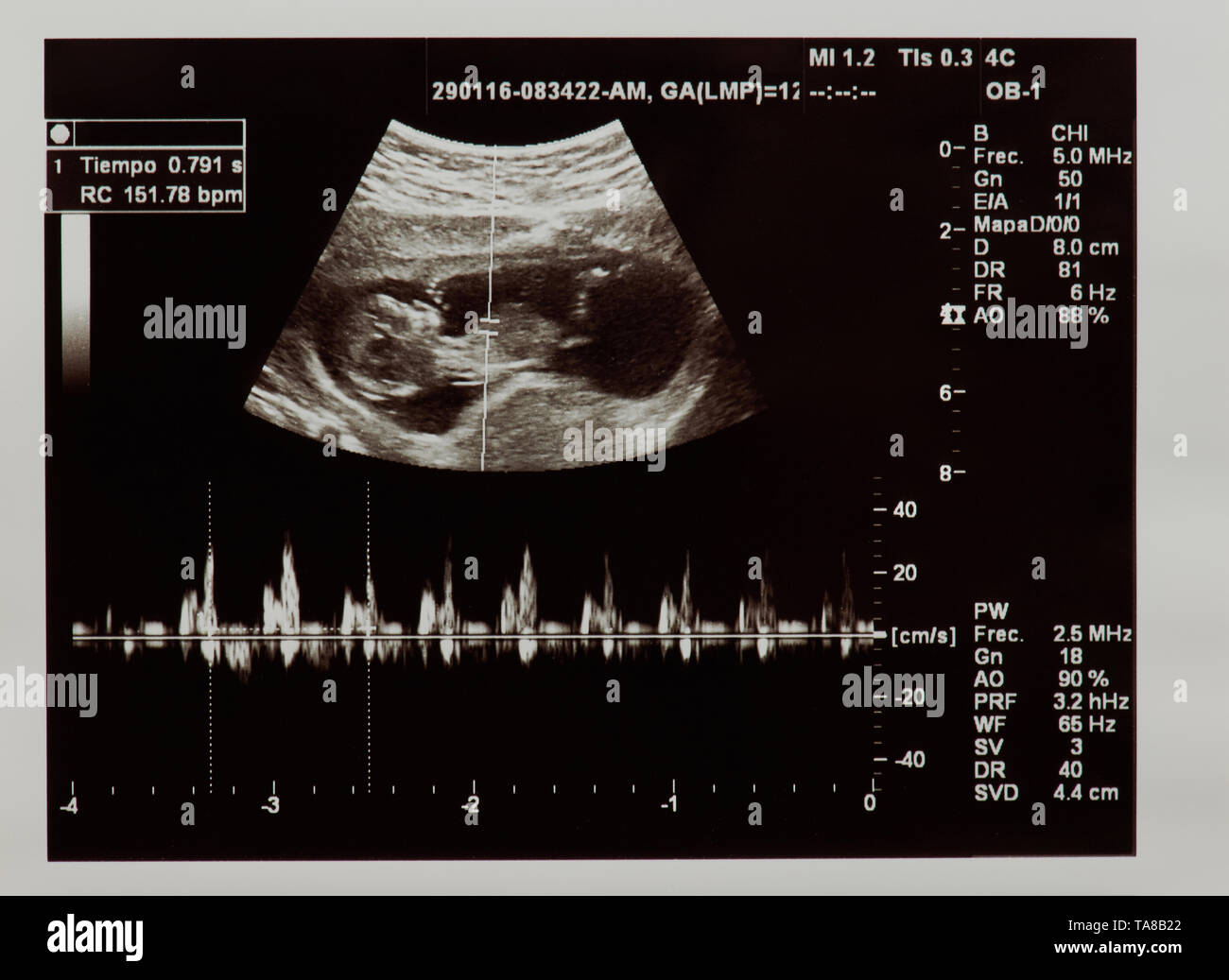 Ultraschall der Zukunft Baby mit Herzschlag Parameter Stockfoto