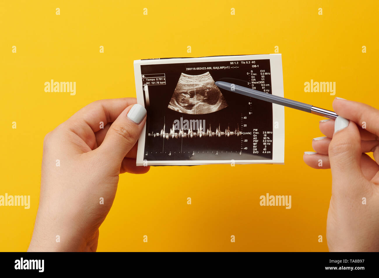 Surfen Ultraschall Foto. Kontrolle Scan der schwangeren Frau Stockfoto
