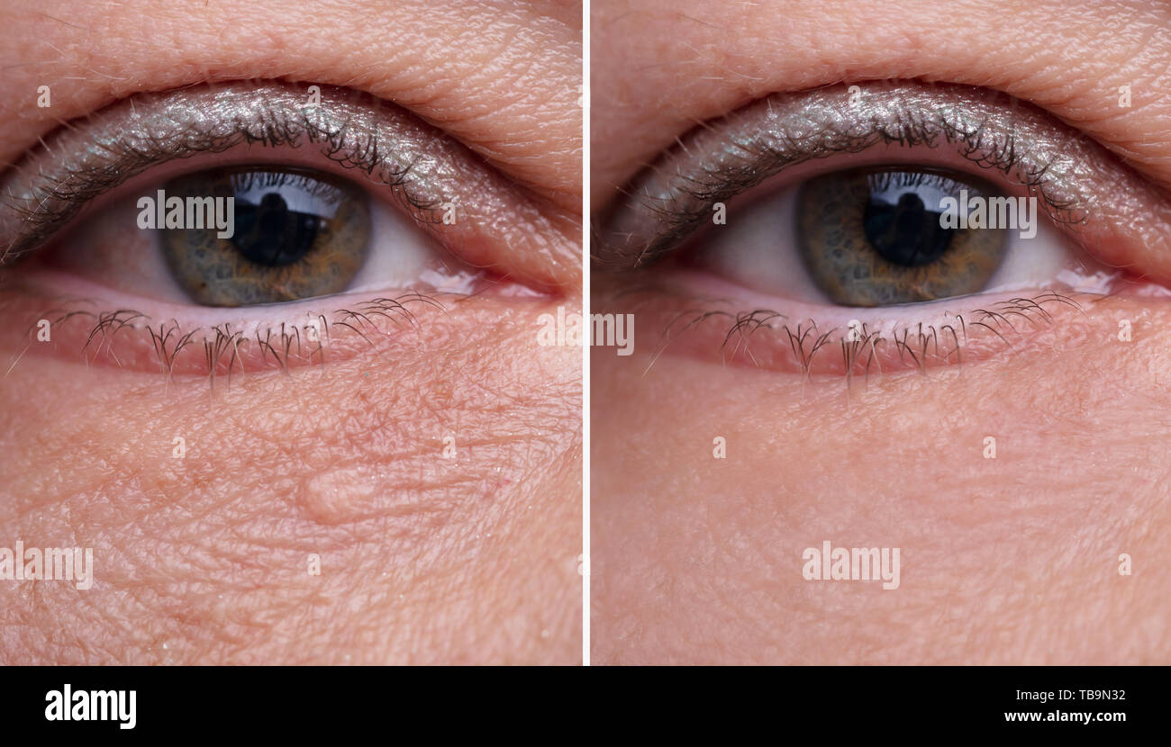 Close-up Woman's Eye Beutel Vor und Nach der kosmetischen Behandlung Stockfoto
