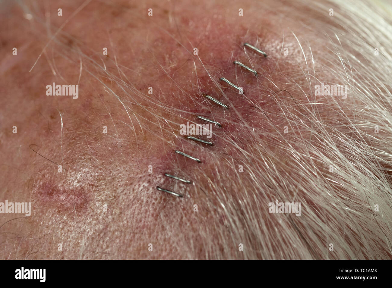 Medizinische Heftklammern in der Nähe der Kopfhaut schnitt erstellt beim Extrahieren von einem Plattenepithelkarzinom über die Mohs chirurgische Technik. Ein weiterer Plattenepithelkarzinom si Stockfoto