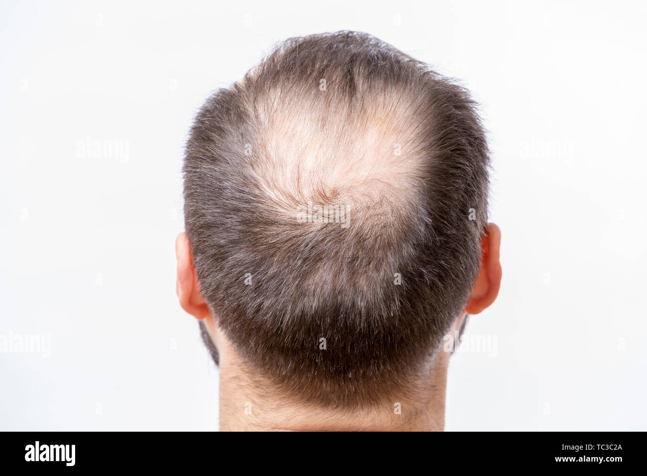 Glatzköpfige Mann hat ein Problem von Kopf Haarausfall und Haarverlust Stockfoto