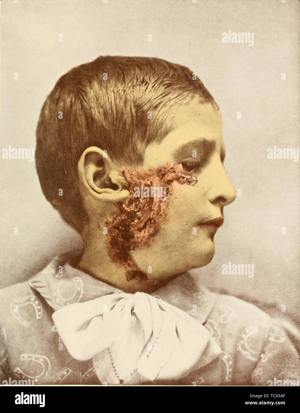 Graviert Porträt eines Jungen mit skrofulose Dermatitis infiziert, ein Zustand der Haut durch Tuberkulose, von fotografischen Atlas Das Buch "Der Erkrankungen der Haut" von George Henry Fuchs, 1905. Mit freundlicher Genehmigung Internet Archive. () Stockfoto