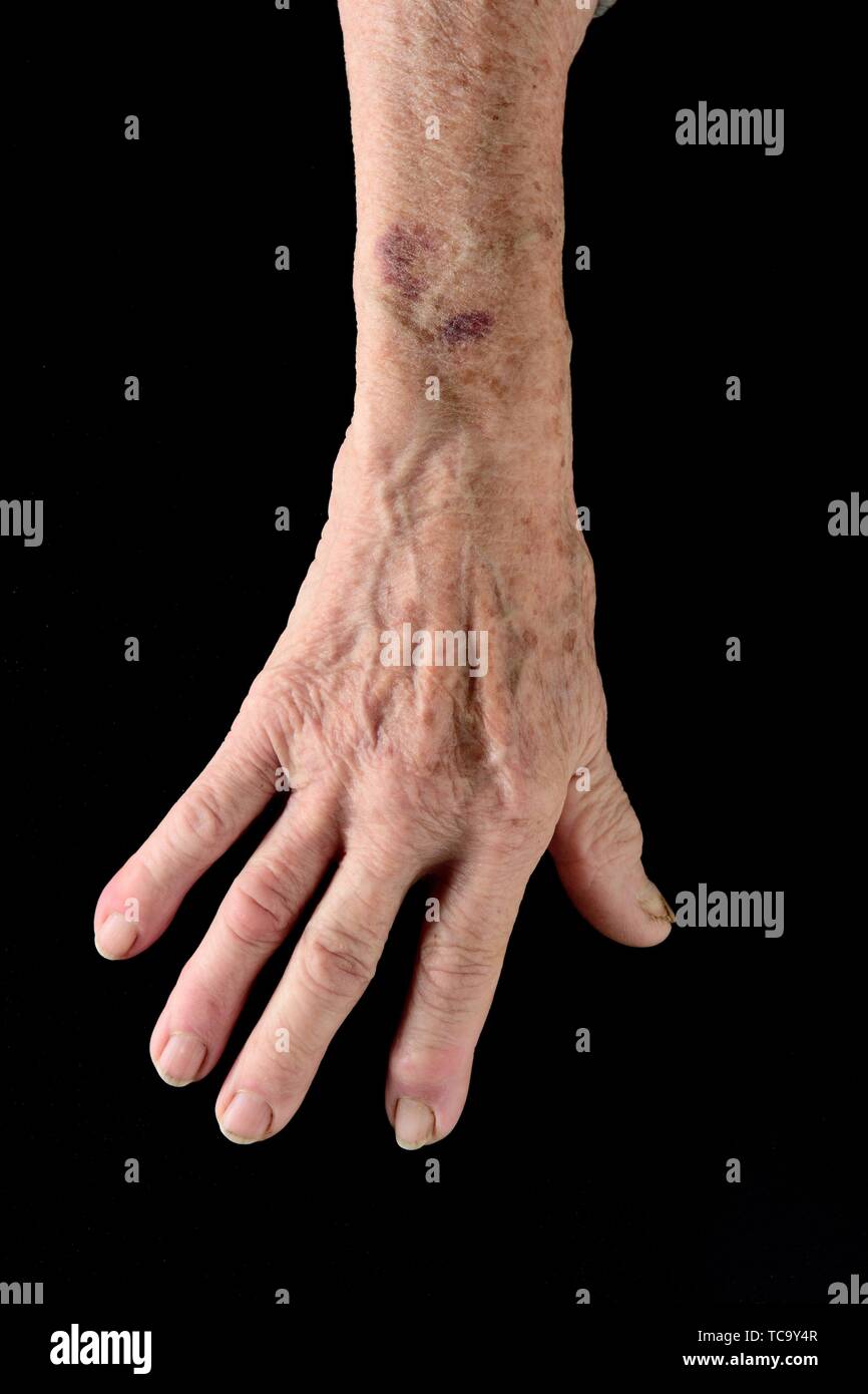 Eine Prellung Stockfotos und bilder Kaufen Alamy