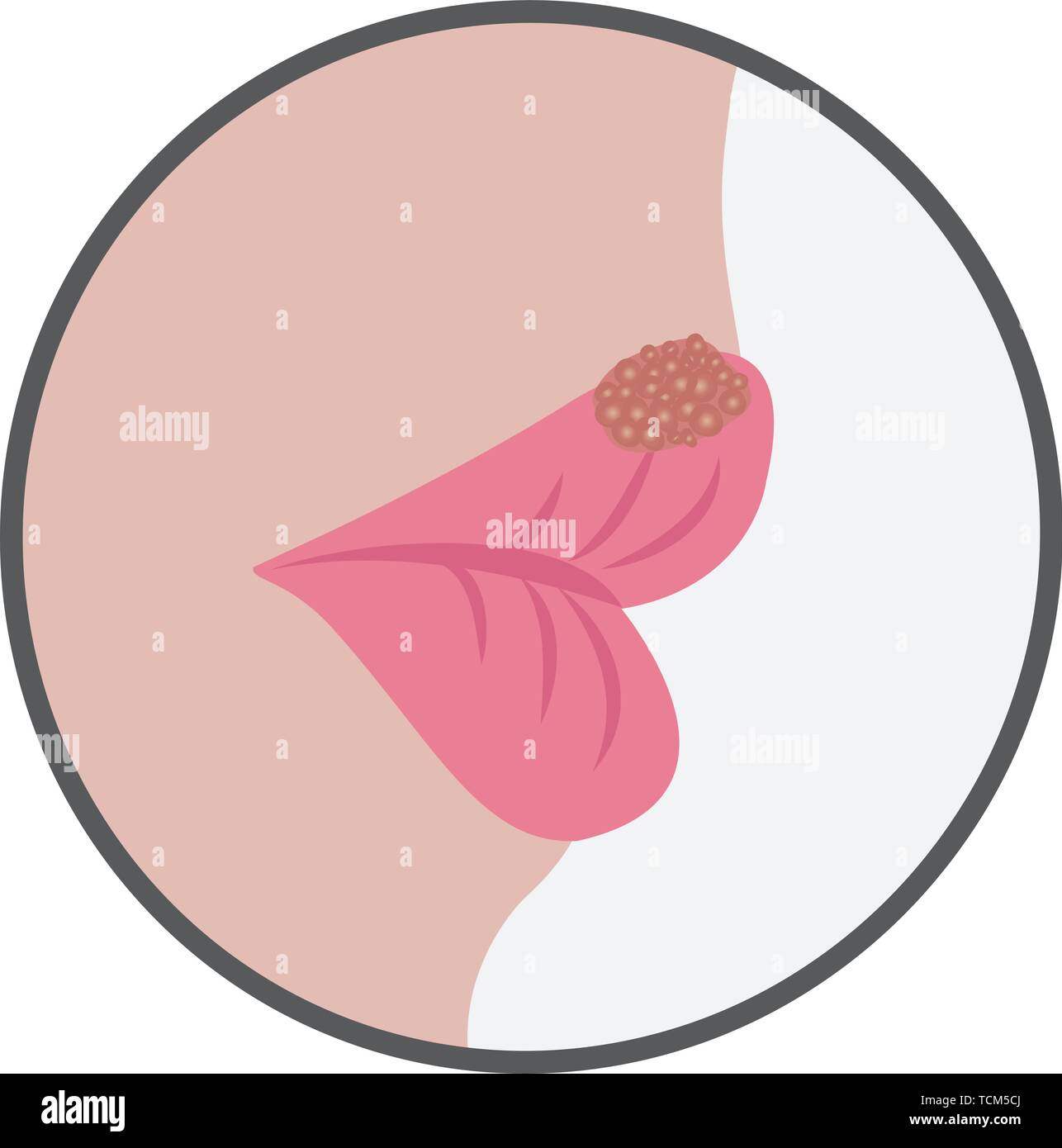 Blase auf eine Lippe von fieberbläschen virale Infektion contageous Vector Illustration auf weißem Hintergrund Stock Vektor