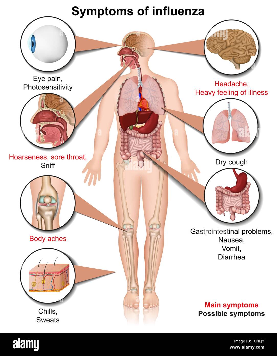 Symptome der Influenza 3 d medical Vector Illustration auf weißem Hintergrund Infografik Stock Vektor
