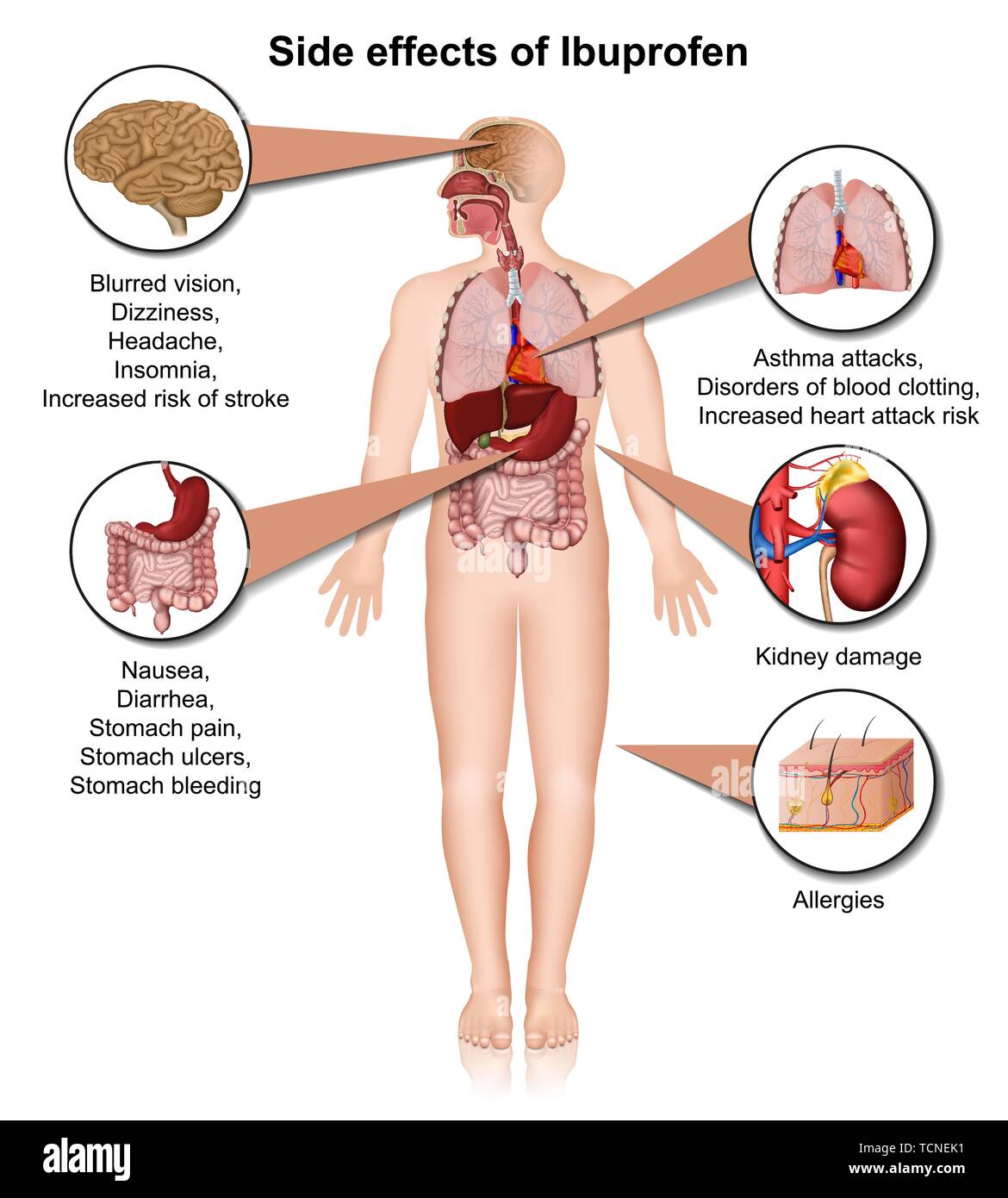 Nebenwirkungen von Ibuprofen 3d medical Vector Illustration auf weißem Hintergrund Stock Vektor