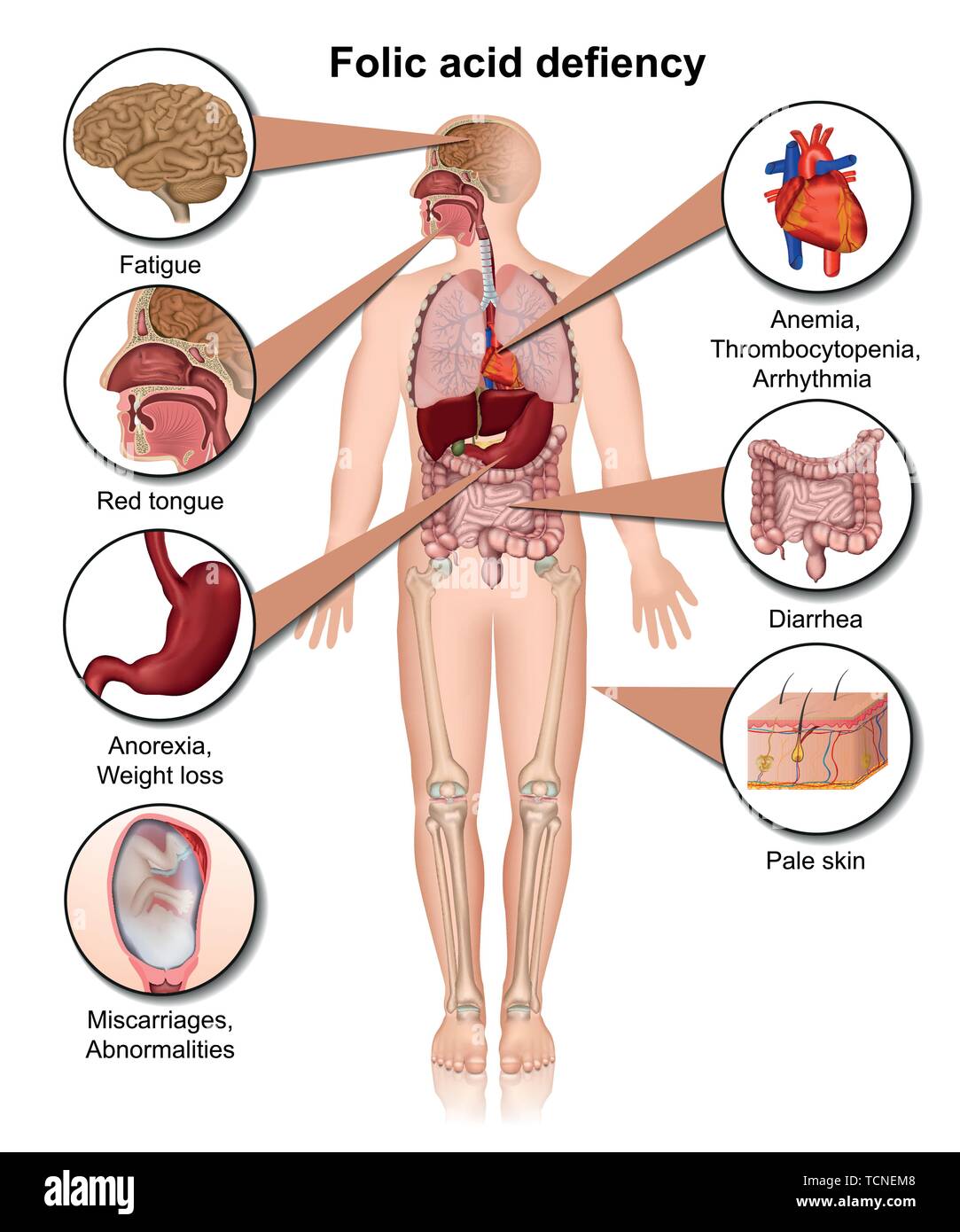 Folsäure defiency 3d medical Vektor-illustration Infografik eps 10. Stock Vektor