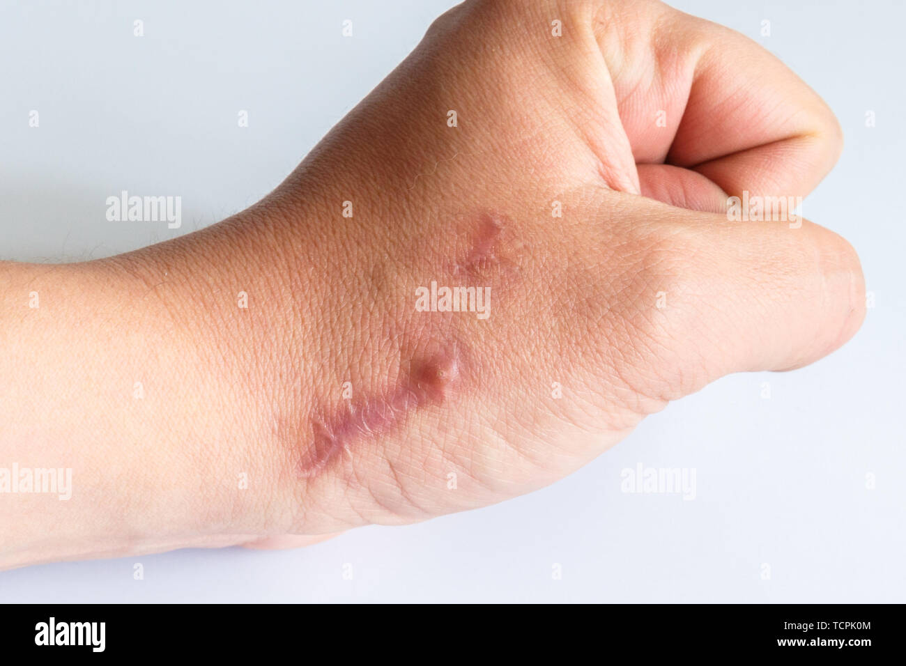 Die Narbe an seinem Arm in der Nähe des Handgelenks auf einem weißen Hintergrund. Zwei Narben nebeneinander auf den Arm, close-up. Stockfoto