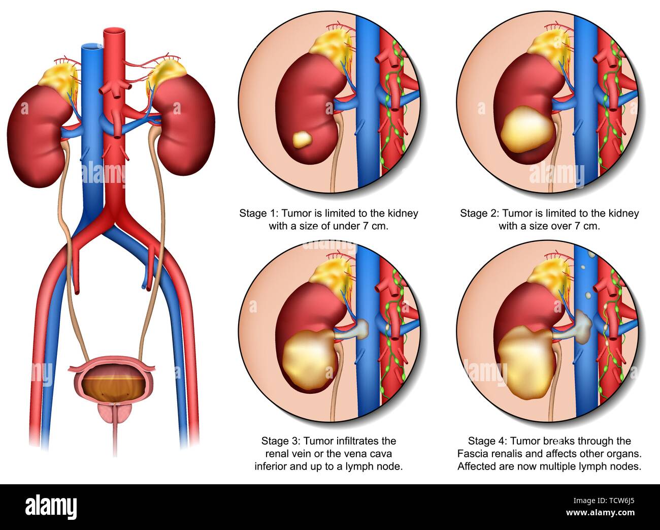 Nierenkrebs Anatomie medial 3d Vektor Illustration auf weißem Hintergrund Stock Vektor