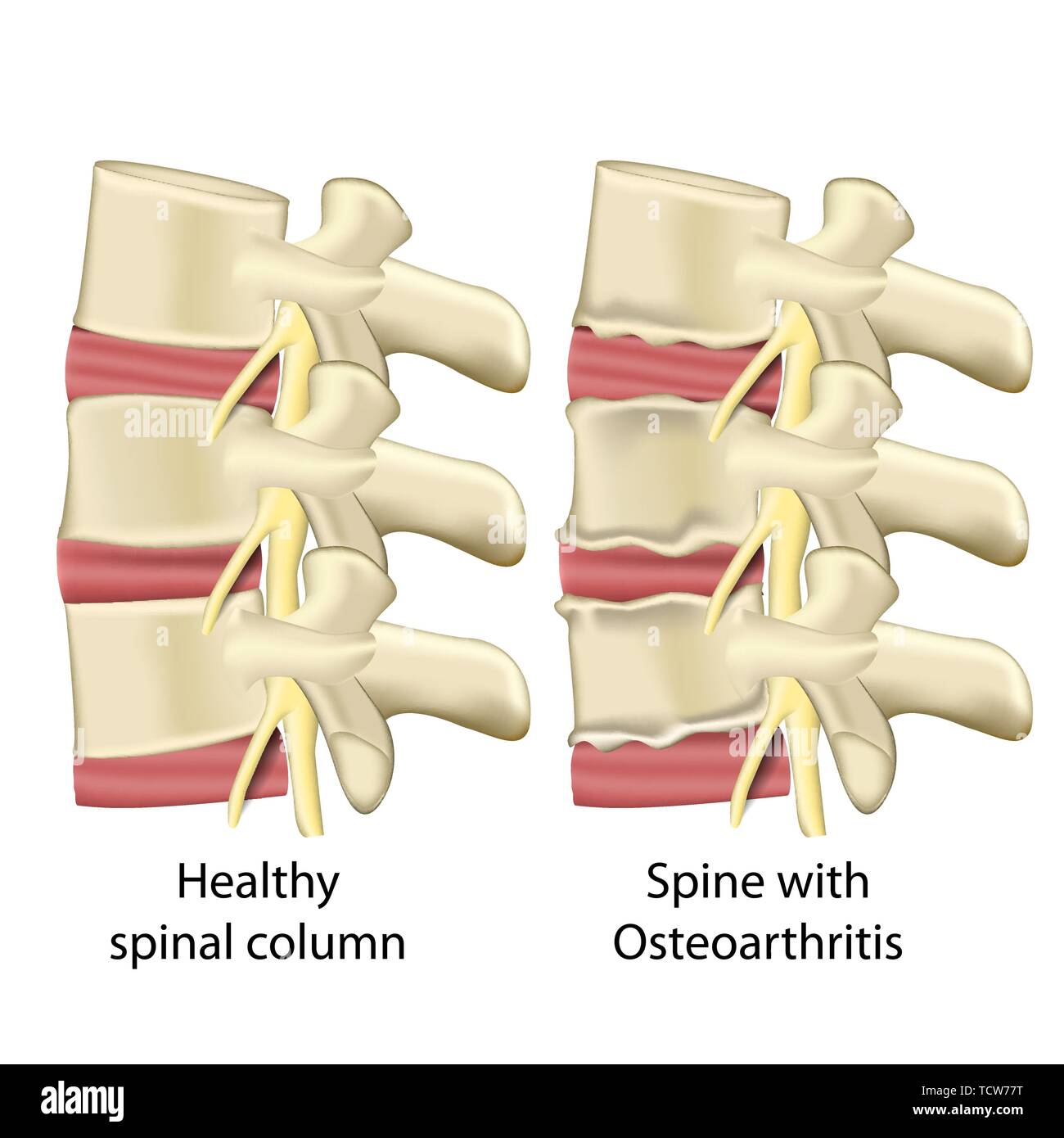 Wirbelsäule mit Osteoarthritis, Wirbelsäule medizinische Vector Illustration auf weißem Hintergrund eps 10. Stock Vektor