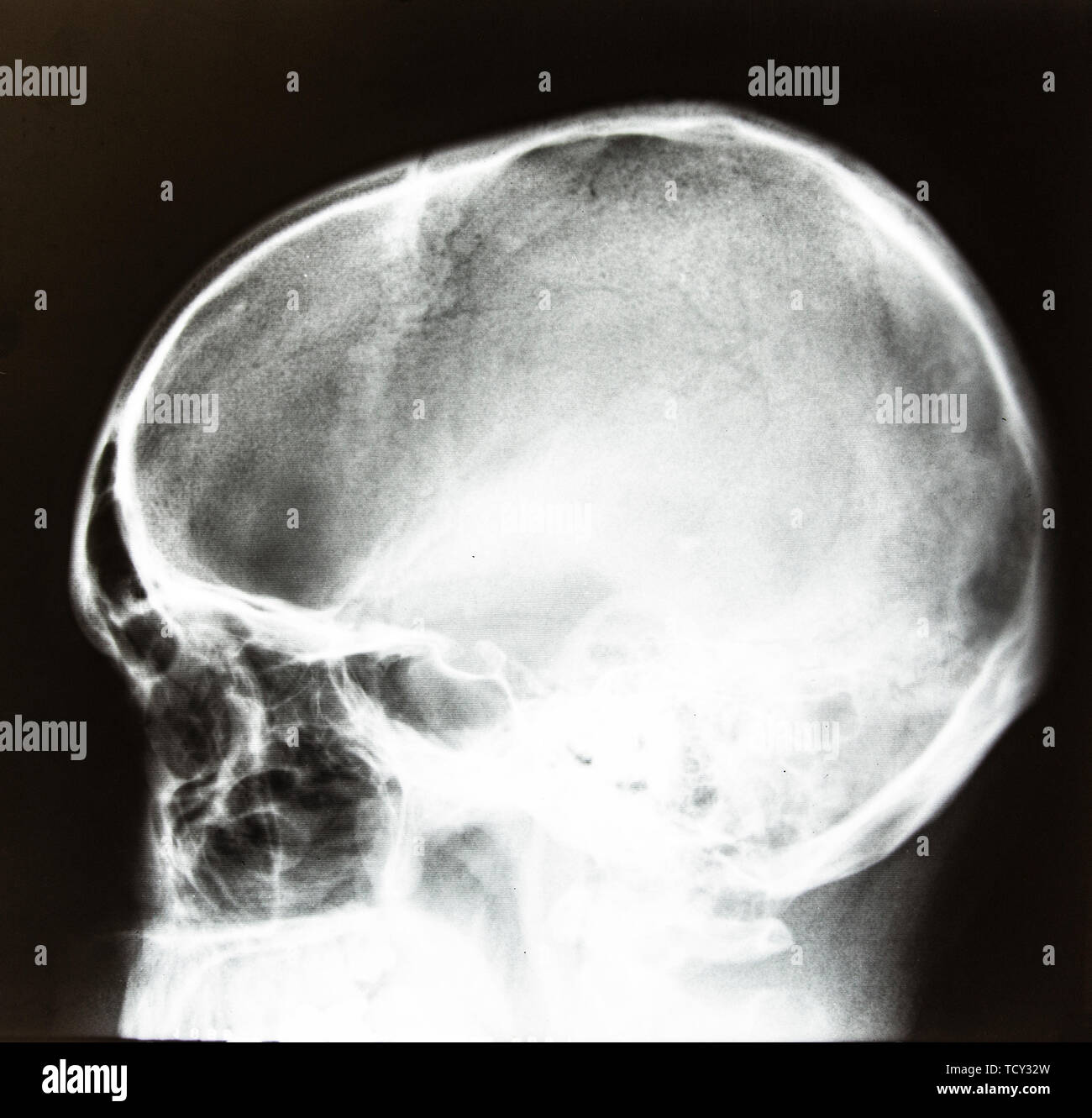 X-ray eines seitlichen Schädel Stockfoto