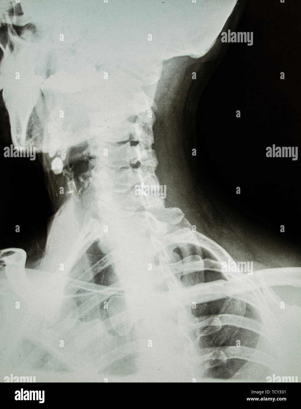 X-ray von Hals und Kopf Stockfoto