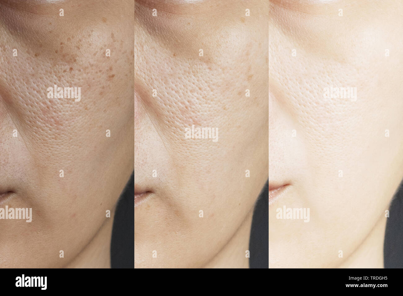 Drei Bilder im Vergleich vor und nach der Behandlung. Haut mit Sommersprossen, Pore, stumpfe Haut und Falten vor und nach der Behandlung t Stockfoto