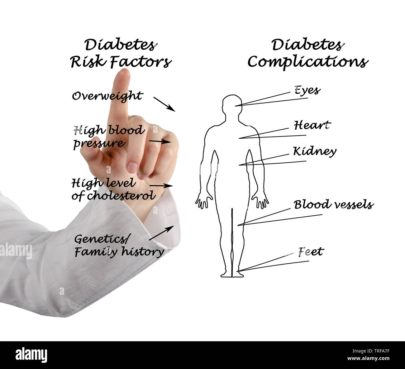 Diabetes Risikofaktoren und Komplikationen Stockfoto