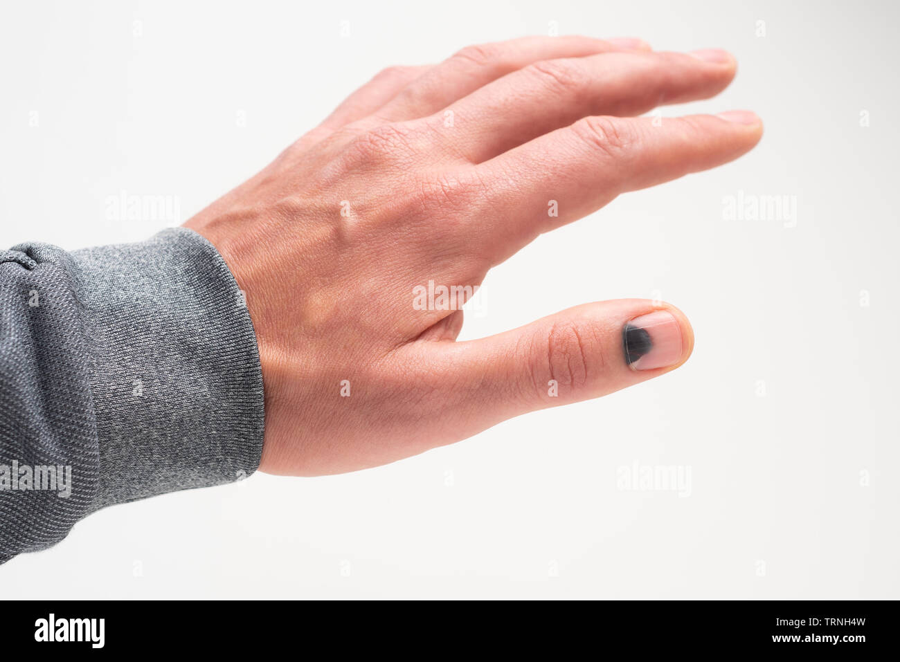 Hämatom Hämatom Stockfotos und bilder Kaufen Alamy