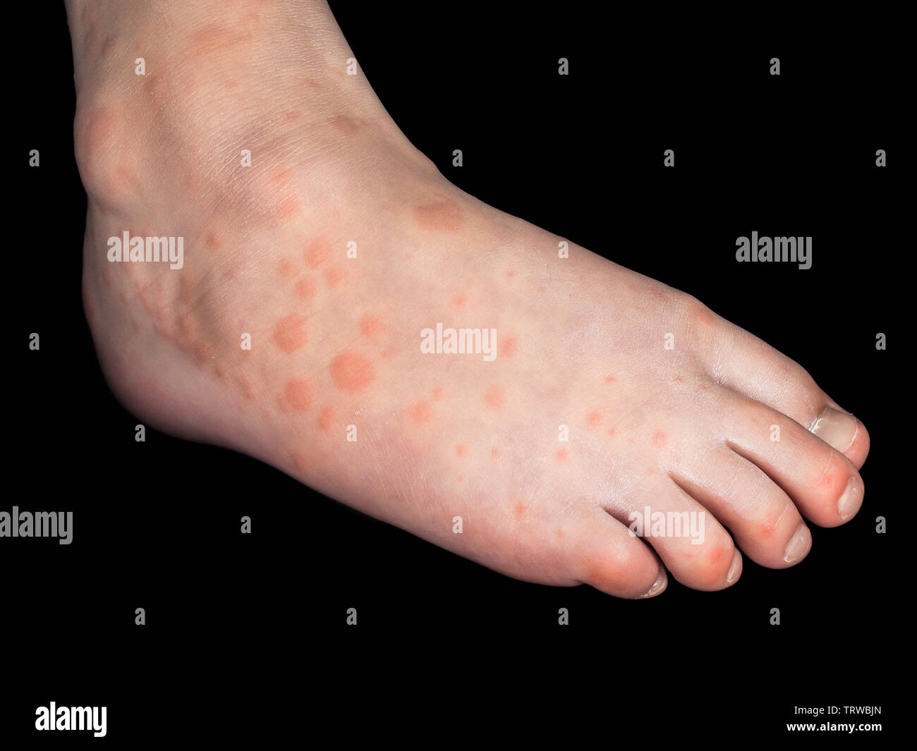 Kind mit roten Ausschlag von Coxsackievirus, auf dem rechten Fuß, isoliert auf Schwarz Stockfoto