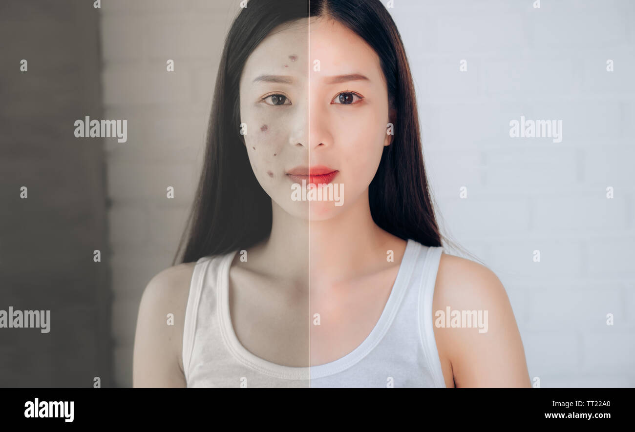 Vergleich Der Asiatischen Frau Akne Gesicht Und Nach Sauberes Gesicht Wenn Sie Hautpflege Make Up Cleansing Foam Akne Gel Stockfotografie Alamy