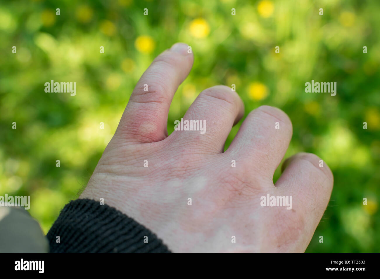 Wunde, Verletzung von einem mückenstich auf einen Finger in den Wald in der Natur Stockfoto